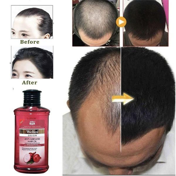 Onion Anti-Hair Loss Oil - 150ml